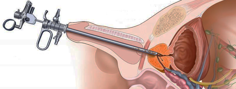 Endourology